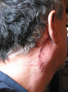 Incision for parotid lymph biopsy